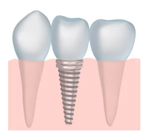 Rock Springs Dental Implants