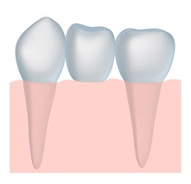 dental bridges rock springs