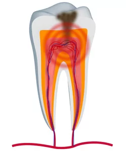 root canal rock springs